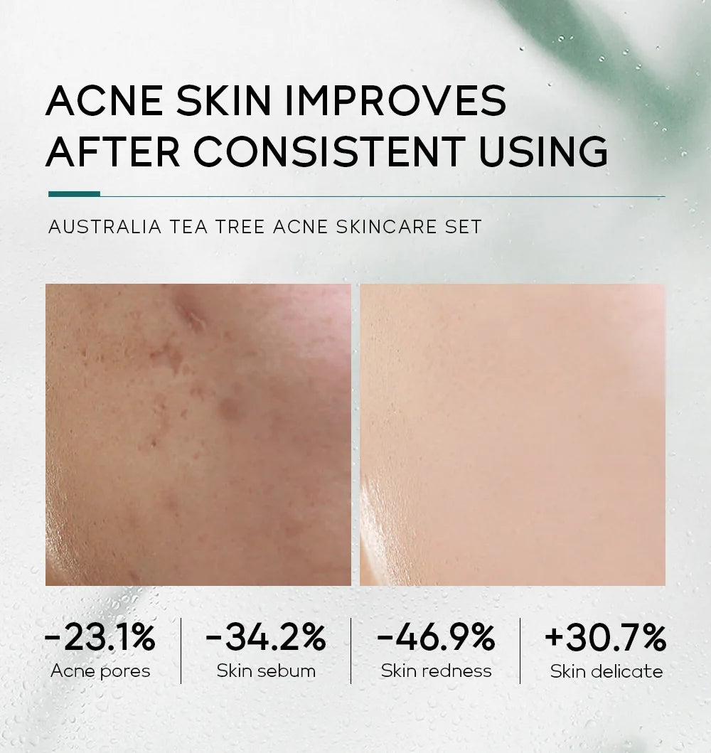 LAIKOU Australia Tea Tree Acne Skincare Five-Piece Set - bodyrelief.uk