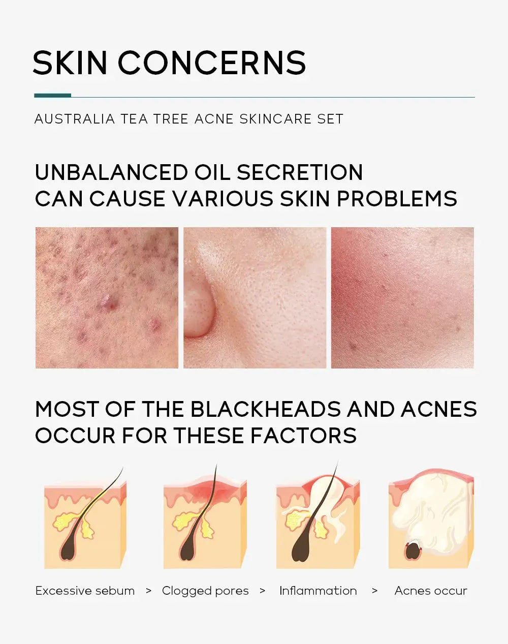 LAIKOU Australia Tea Tree Acne Skincare Five-Piece Set - bodyrelief.uk